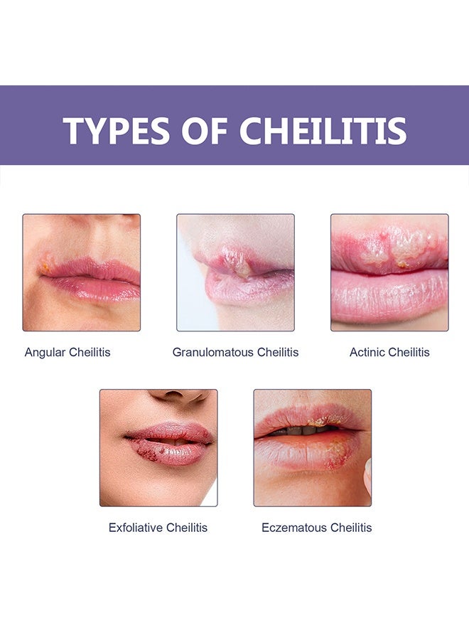 EELHOE Discreet Healing Patch, Health Lip Clear Invisible Cold Sore Patches For Lips Help Soothe Shield And Hide Cold Sores, Helps Prevent Contamination, Fever Blister Bandages For Women And Men (36PCS) - Image 5